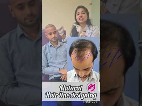 How to design natural hairline in hair transplant- MBBS MD (MAMC) (SKIN)- HINDI 2022