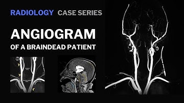 This is the angiogram of a braindead patient | Radiology | truefisp