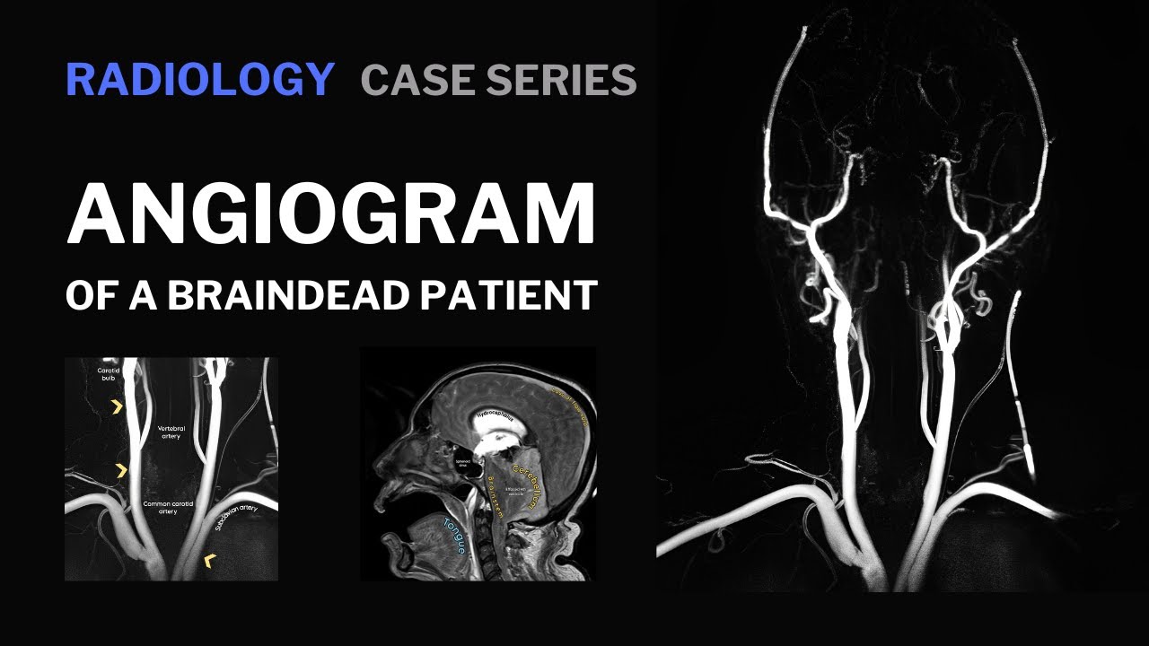 Angiogram of a braindead patient.