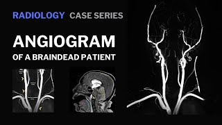 This is the angiogram of a braindead patient | Radiology | truefisp