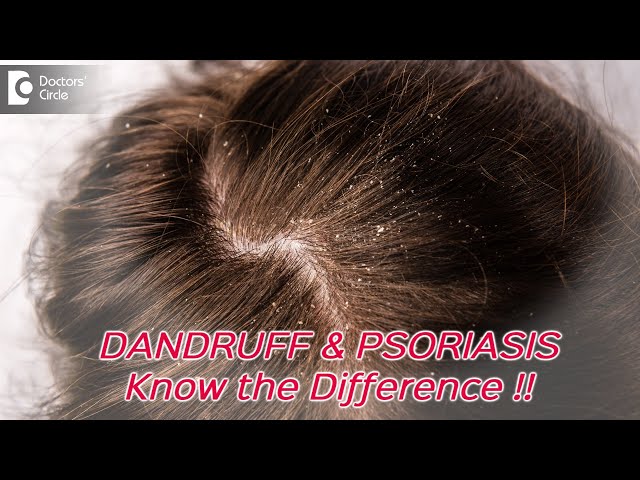 Difference between dandruff and psoriasis - Dr. Divya Sharma  | Doctors' Circle class=