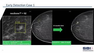 Mammography Workflow Reduction using Artificial Intelligence Based Triage Software