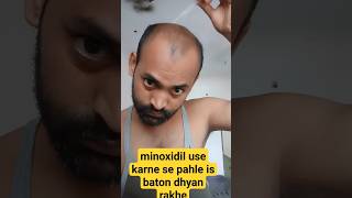 how to use Traya minoxidil  | Traya |Traya hair review | shorts