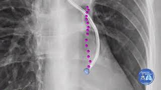 5 mm Lung nodule biposy using robotic bronchoscopy with the fluoroscopy augmentation CBCT