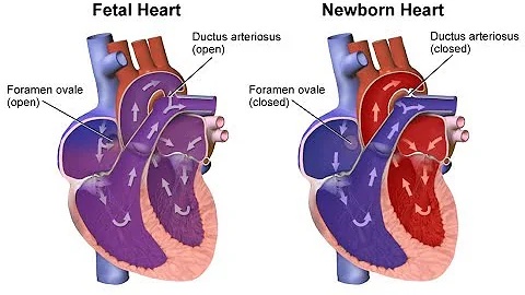 ¿Qué es una cardiopatía incipiente?