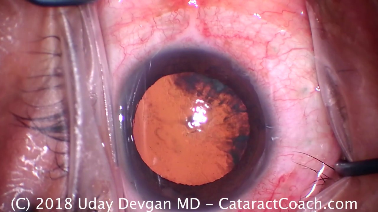 Correct Management of a Dropped Nucleus During Cataract Surgery YouTube