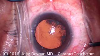 Correct Management of a Dropped Nucleus During Cataract Surgery