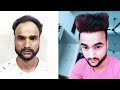 Hair transplant journey 1 year hair transplant result  hair transplant guide