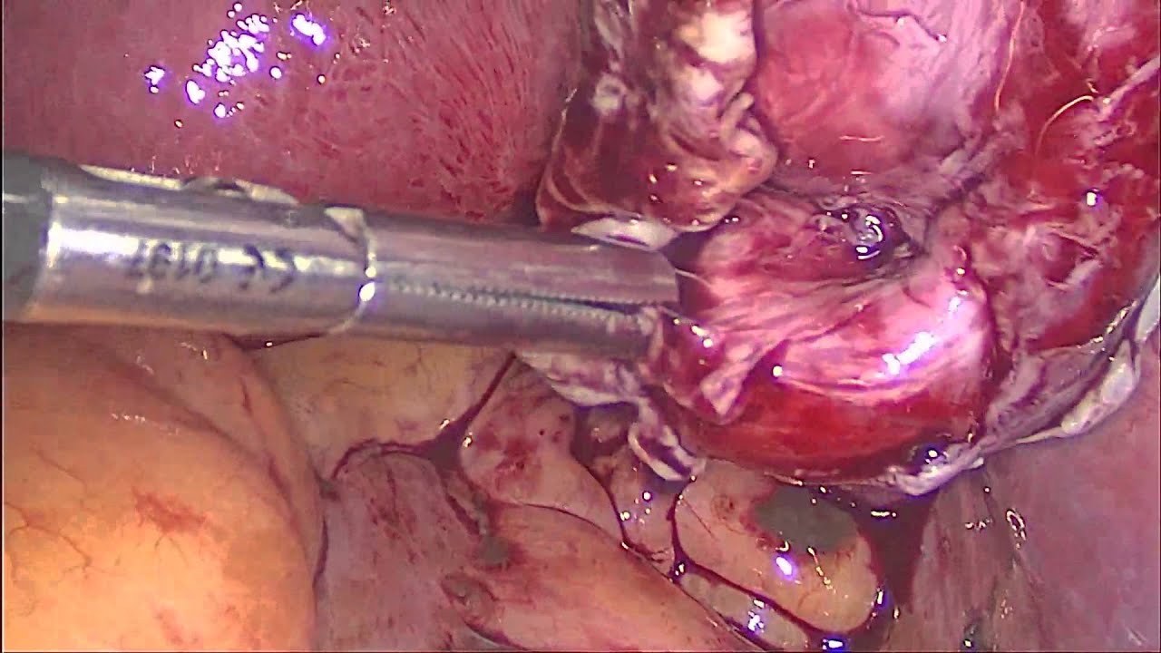Удаление эндометриоидной кисты - YouTube