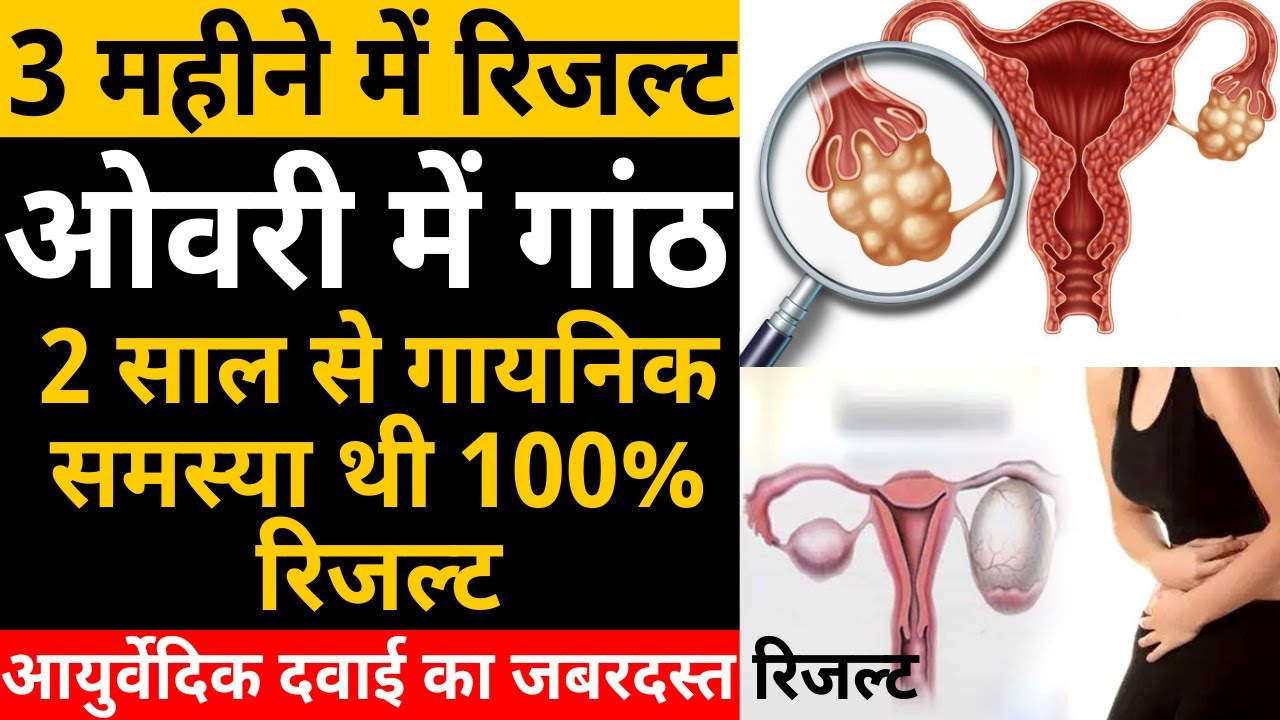 ओवरी में गांठ की दवा ovary me ganth ovary me ganth hone ke karan
