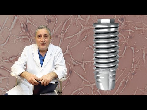 Video: Čudni Implantati - Alternativni Prikaz