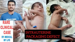 INTRAUTERINE PACKAGING DEFECT | Rare Clinical Case