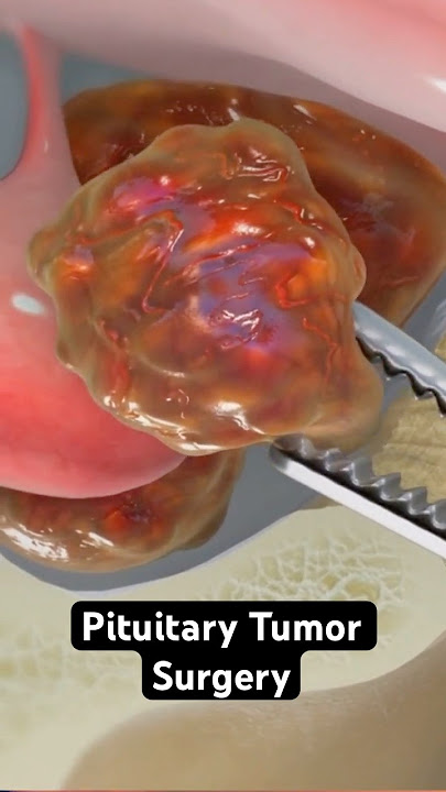 Pituitary Tumor Surgery (3D Animation)