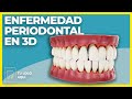 ENFERMEDAD PERIODONTAL 🦷 Vídeos de odontología en 3D - Animaciones 3D para Clínicas Dentales