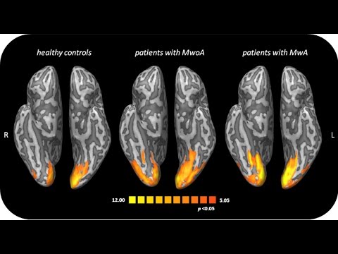 Video: Cosa fa l'emicrania al cervello?