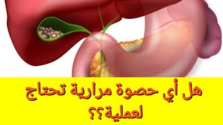 حصوات المرارة وطرق علاجها وبعض المفاهيم الخاطئة (الجزء الأول)_هل نعمل عملية أم نكتفي بالمتابعة؟