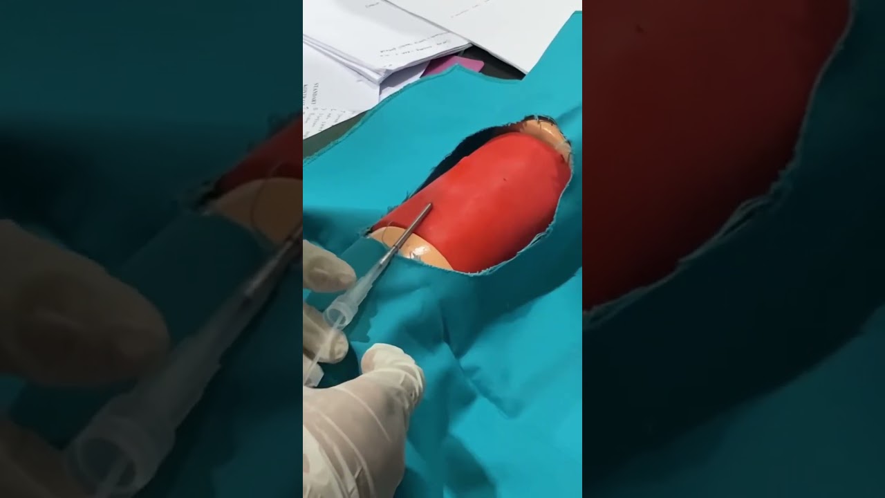 Pemasangan KB implan PART 2 💓✌🏻