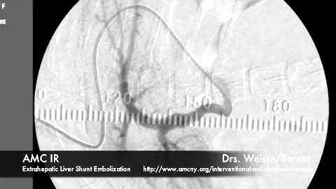 Interventional Radiology: Liver Shunt Embolization