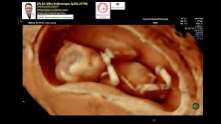 Download lagu Pemeriksaan hamil 13 minggu