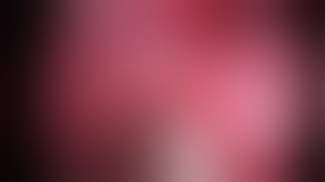 Uniportal VATS right common basal (RS7-10) segmentectomy (repeated surgery)