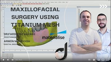 maxillofacial surgery using titanium mesh(p2)