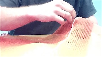 Instruction video erc how to remove the sewed wire from the Baxmatic bag