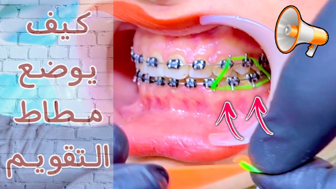 مطاط التقويم العمودي | علم مصر 🇪🇬 في تقويم الاسنان 