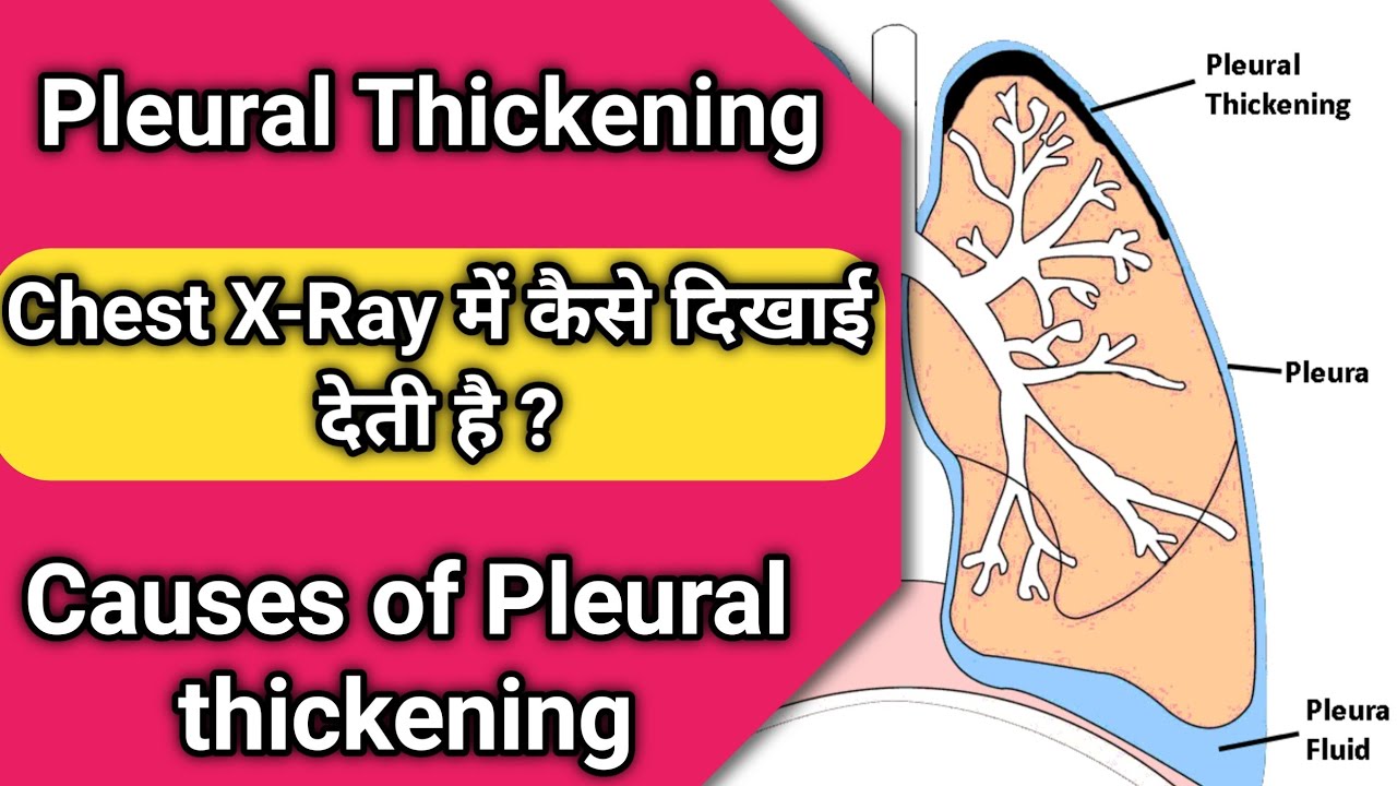 Pleural Thickening Of The Lungs Pleural Thickening Chest X Ray YouTube