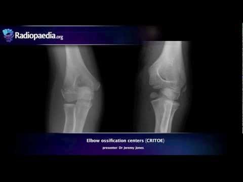 Elbow ossification centers (CRITOE) - radiology video tutorial