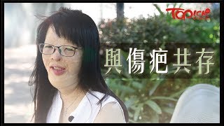 Topick健康8歲火海毀容雙親身亡　堅強女生3年歷40次手術疤痕是生活一部分