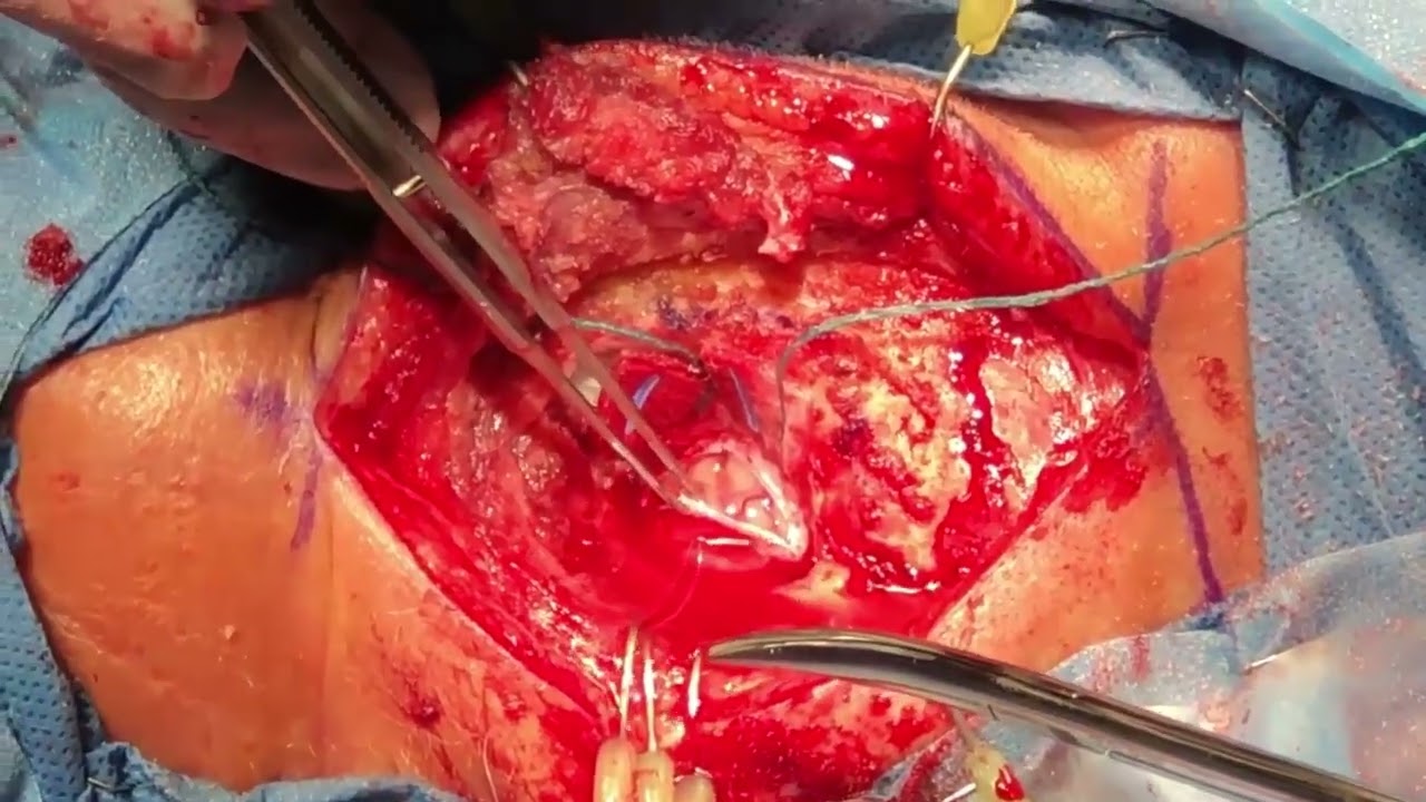 Video 200 1 Microvascular Decompression and Internal Neurolysis for Trigeminal Neuralgia