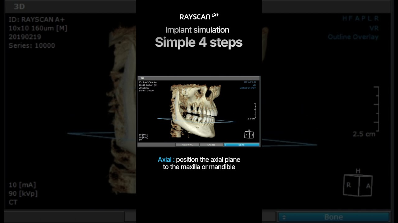 【RAYSCAN α+】Implant simulation Simple 4 steps