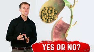 Should I Remove My Gallbladder If I have Stones? - Dr.Berg