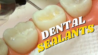 How to Apply Dental Sealants: Step by Step Procedure | In Office to Hands On Dental Training
