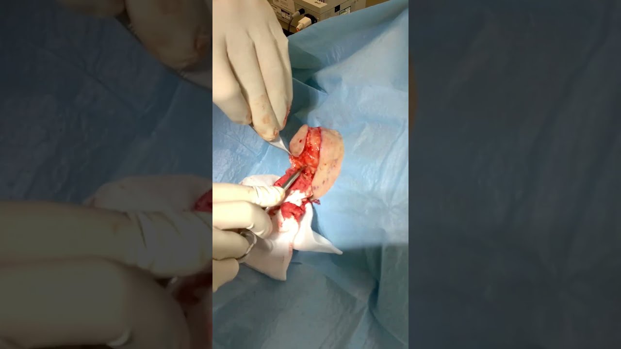 CYST Removal at The STAIANO Clinic