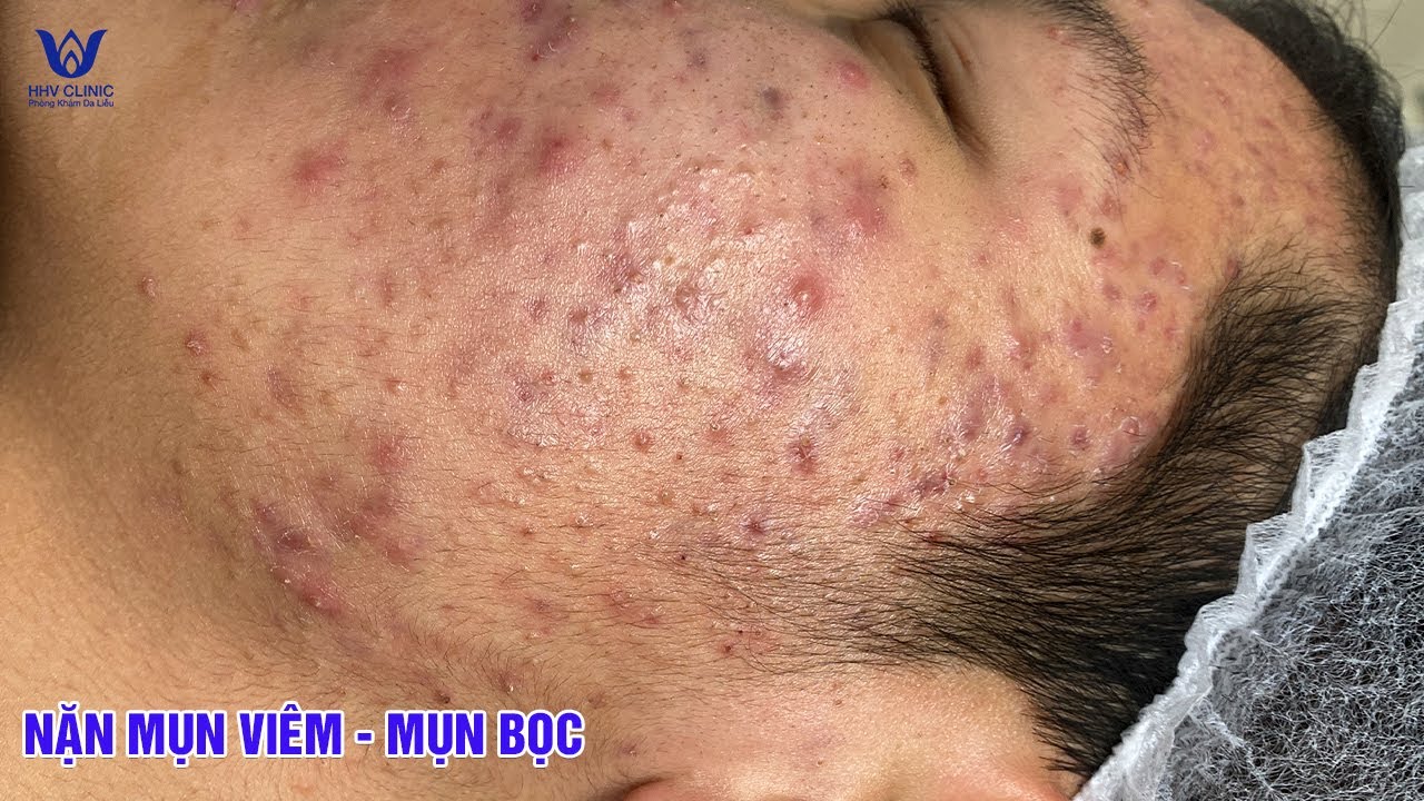 Điều trị mụn viêm, mụn bọc, cam kết hiệu quả ngay sau 1 buổi - Tại phòng khám da liễu HHV Clinic.