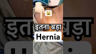 इतना बड़ा Inguinal Hernia 😱 | Laparoscopic Surgery LIVE | You won’t believe this! #hernia