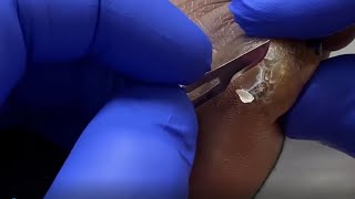 BIGGEST CALLUS EVER - Removing Hard Foot Callus #9 - Foot Care Podiatry