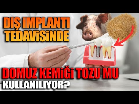 Diş implantı tedavisinde domuz kemiği tozu mu kullanılıyor?