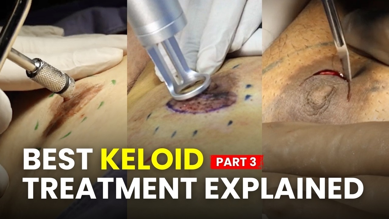 Keloid Treatment Journey: How to Get Rid of Keloid Scars | Part 3 | Dr