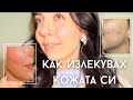 АКНЕ 101 ★ ПОРИ . ПЪПКИ . БЕЛЕЗИ