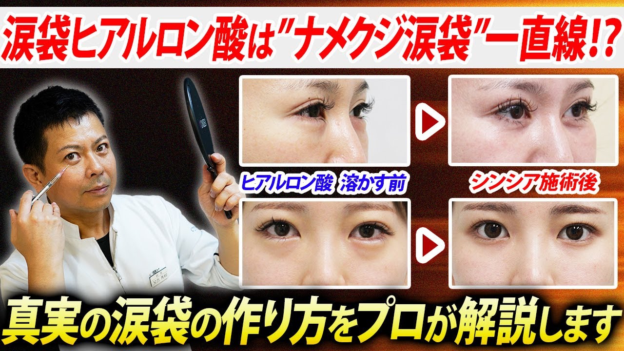 【涙袋形成術】安易な涙袋ヒアルロン酸は“ナメクジ”一直線！？正しい涙袋の作り方をプロが解説