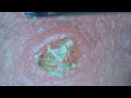 0279 keratin plug removal nose