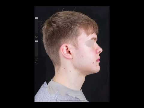 War sehr schmerzhaft🥲 Bimax OP🏥 #bimax #trend #operation