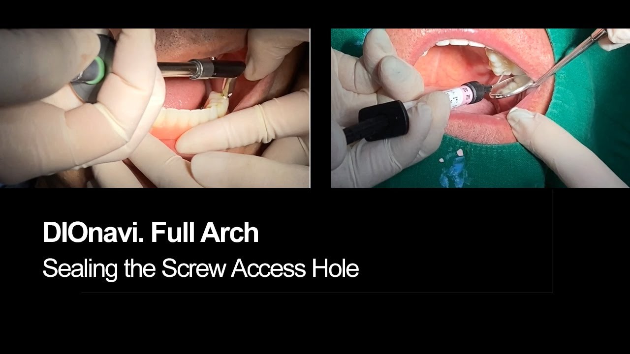 DIOnavi. Full Arch Sealing the Screw Access Hole