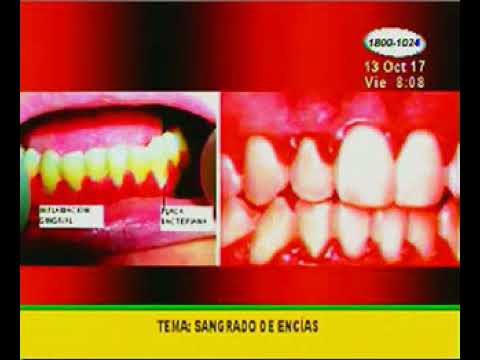 sangrado de encías y diabetes