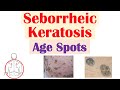 Seborrheic Keratosis (“Age Spots”) | Risk Factors, Causes, Skin Lesions, Diagnosis, Treatment