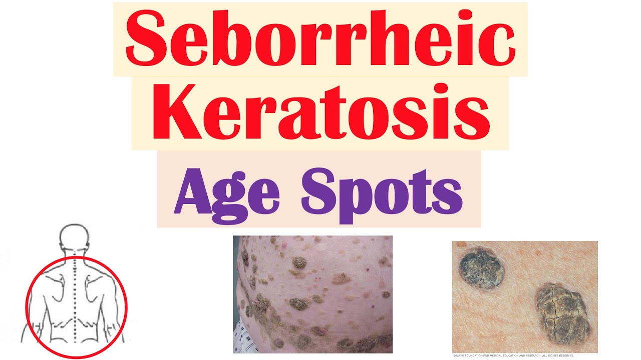 Seborrheic Keratosis “age Spots” Risk Factors Causes Skin Lesions