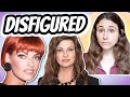 Linda Evangelista BRUTALLY DISFIGURED from COOLSCULPTING | Dermatologist Responds | Dr Dray