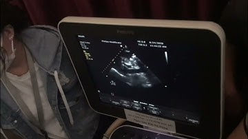 Siêu âm IVC trong cấp cứu bs Tú Thanh BVNĐ1